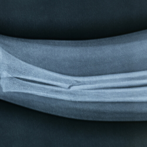 Tratamiento de fracturas